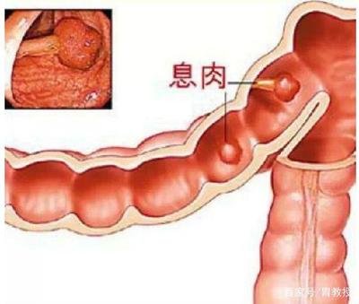 胃腸息肉生長有信號，該預(yù)防時要預(yù)防！